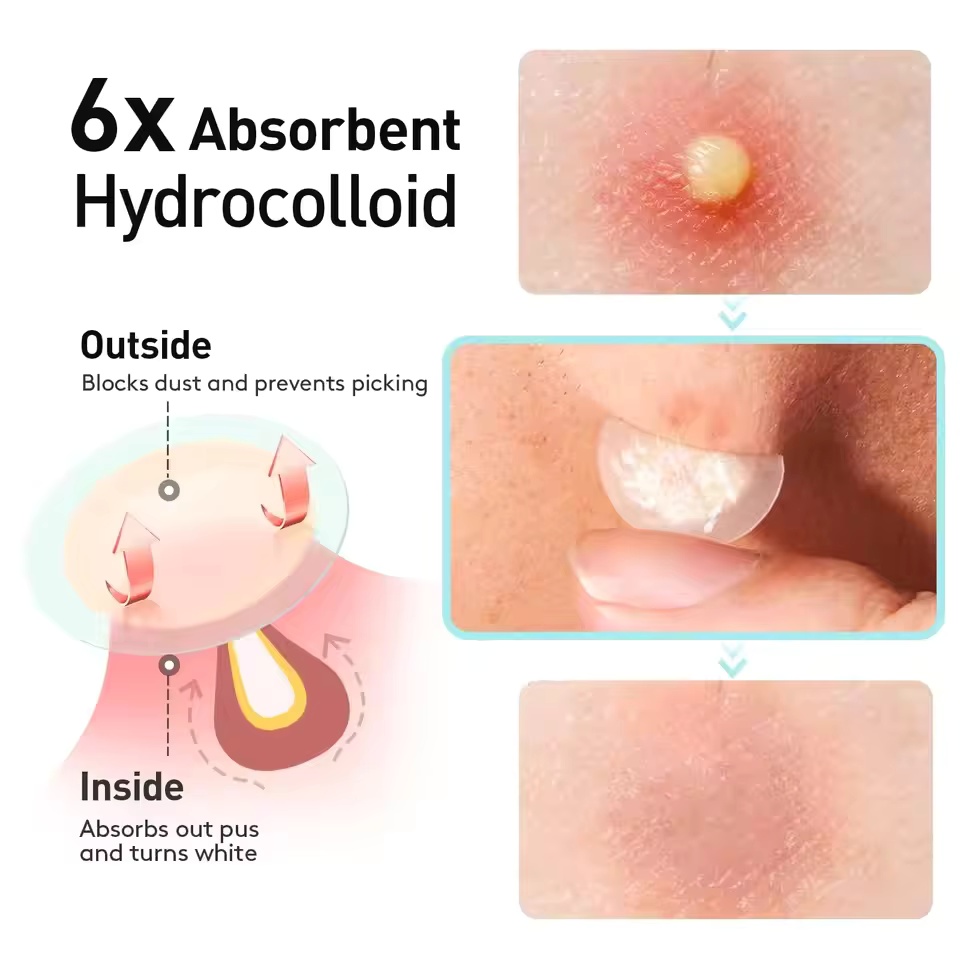 360 pieces/box acne patches -  - đánh giá và giá Face Oil